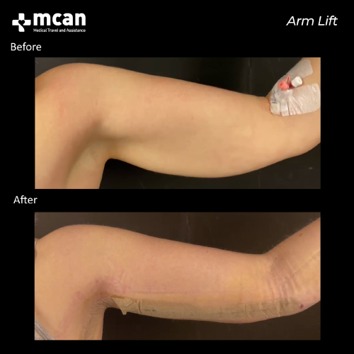 Arm Lift Turkey Before and After 1