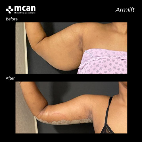 Arm Lift Turkey Before and After 3