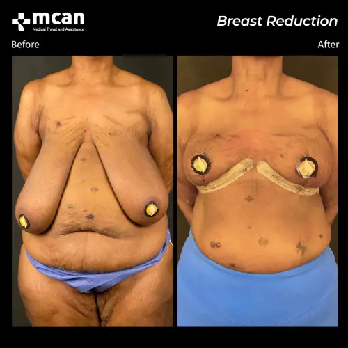До и после операции по уменьшению груди в Турции 2