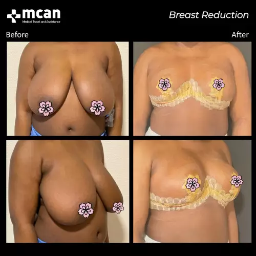 До и после операции по уменьшению груди в Турции 3
