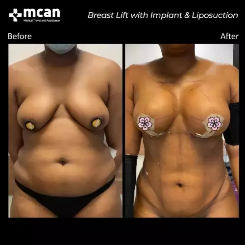 Breast Before After 3