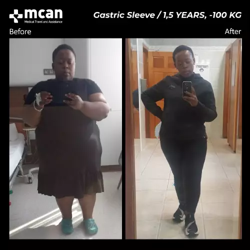Gastric Sleeve Before After 1