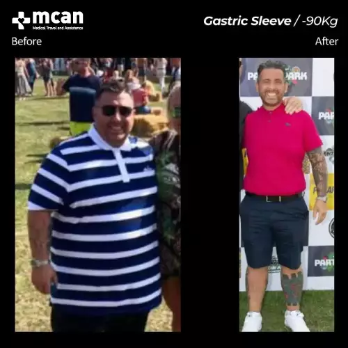 Gastric Sleeve Before After 2