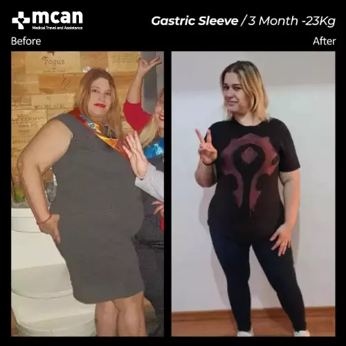 Gastric Sleeve Before After 3