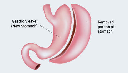 How is Gastric Sleeve Surgery Turkey
Performed?