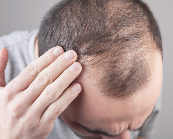 Pourquoi Arrive-t-elle la Chute de Cheveux? Pourquoi Arrive-t-elle la Chute de Cheveux?
