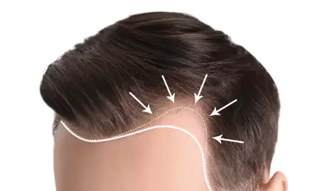 Hair Transplant