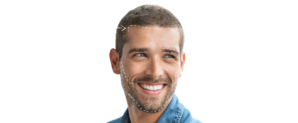 Hair Transplant - Mcanhealth