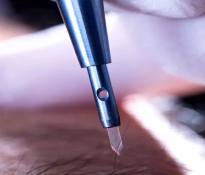 Sapphire Hair Transplant Technique