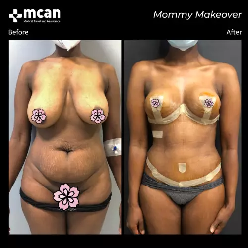 До и после Mommy Makeover 2