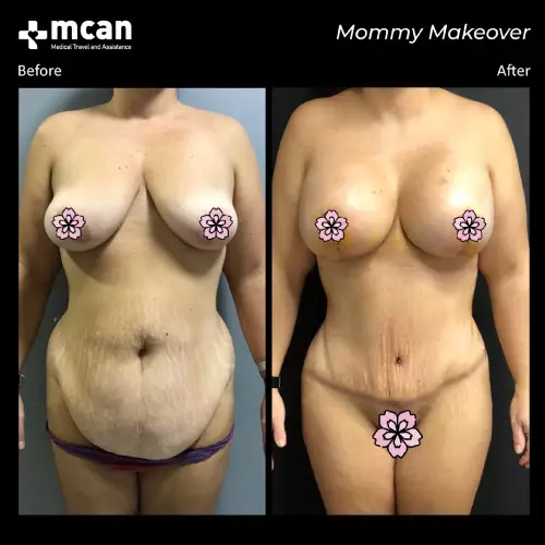 До и после Mommy Makeover 3