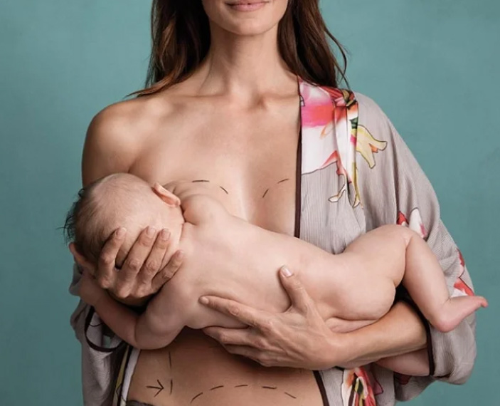 Что такое Mommy Makeover Что такое Mommy Makeover