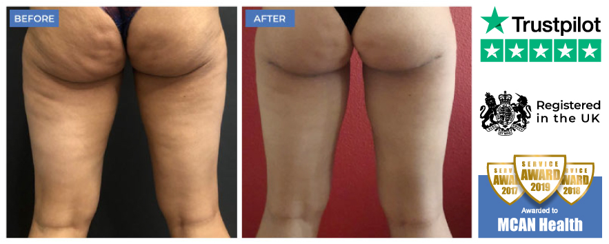 Thigh Lift Turkey Thigh Lift Turkey