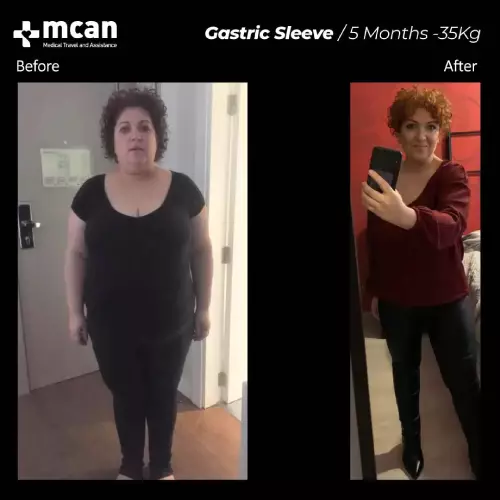 До и после операции по снижению веса 1