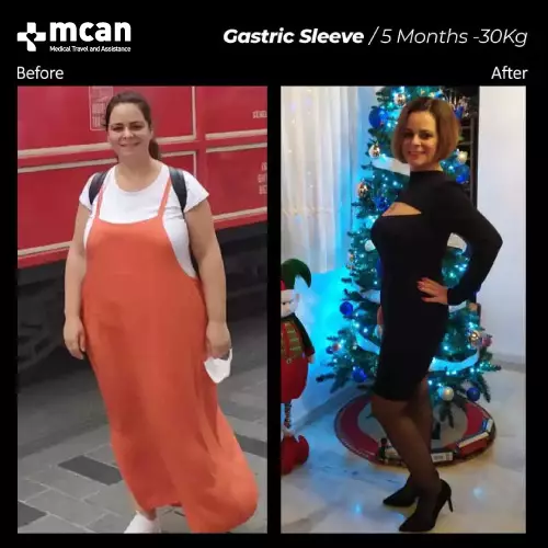 До и после операции по снижению веса 3