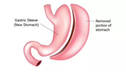 Gastric Sleeve Surgery Turkey