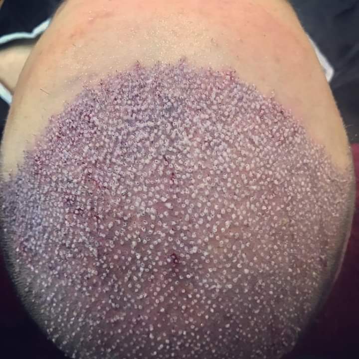 dead skin after hair transplant dead skin after hair transplant