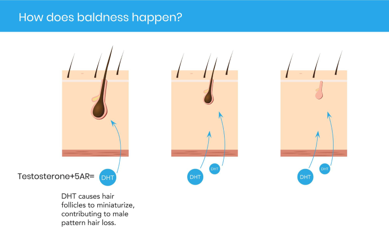 how does baldness happen how does baldness happen