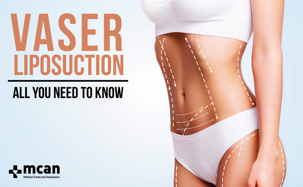 Vaser liposuction, all you need to know