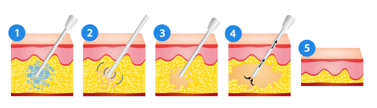 Was ist Vaser- Liposuktion? 