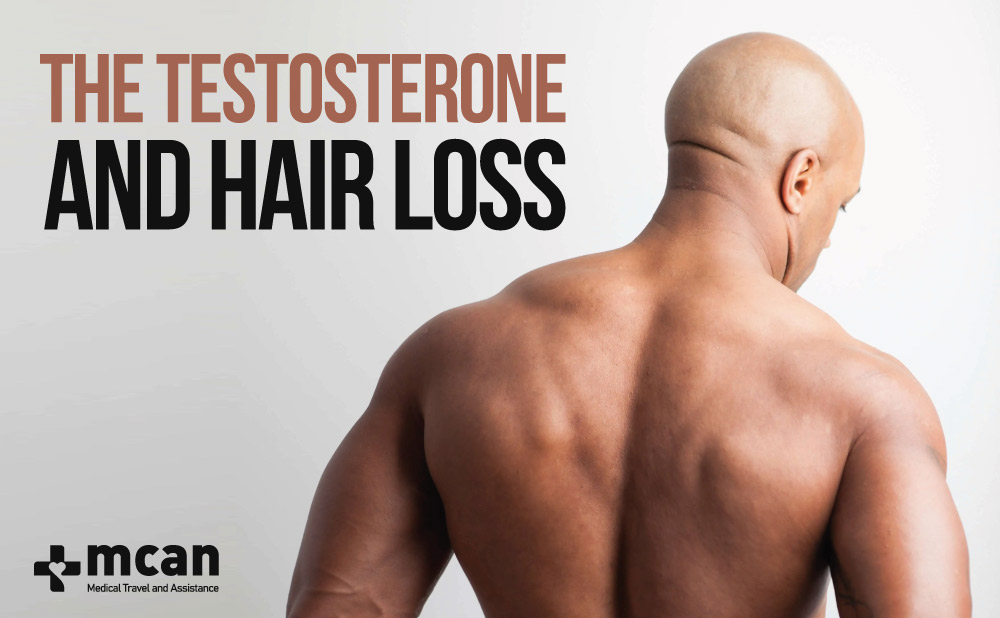 Is there any correlation between testosterone and hair loss