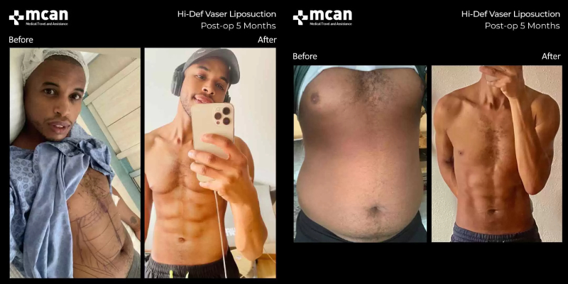 Hi-def vaser liposuction 