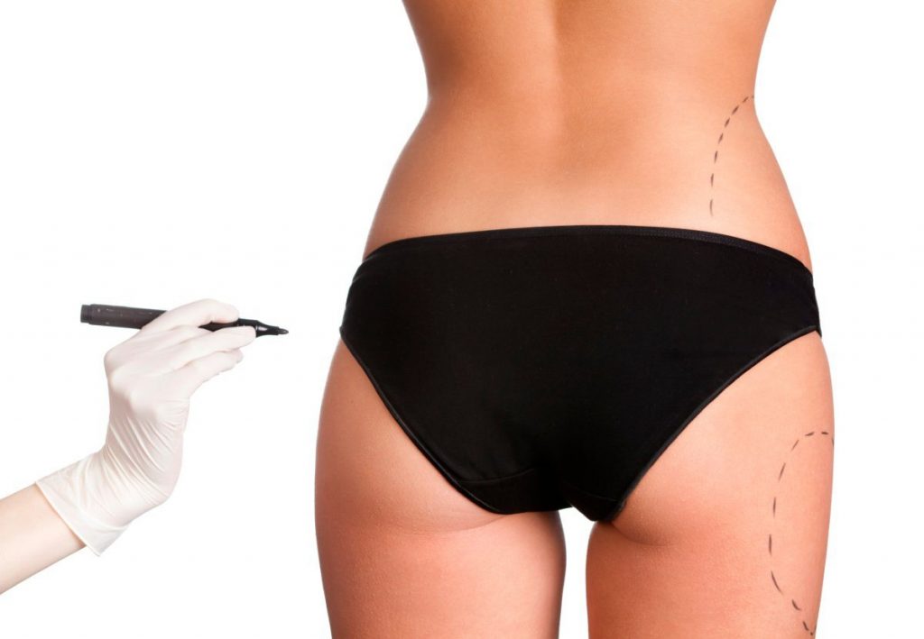 Mcan Health Liposuction Turkey