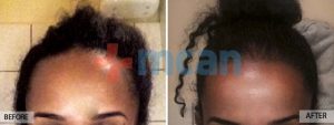 Antes y después del trasplante capilar – 6 meses después. 2.100 injertos.