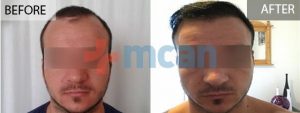 Antes y después del trasplante capilar en Turquía