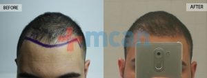 Antes y después del trasplante capilar en Turquía