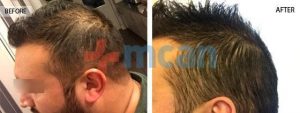 Vorher – nachher Haartransplantion in der Türkei