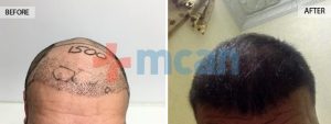 Vorher – nachher Haartransplantion in der Türkei