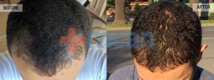 6 Monaten nach der Haartransplantation