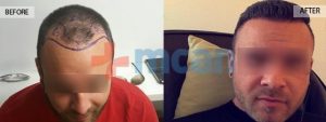 Antes y después del trasplante capilar – 6 meses después. 4.100 injertos