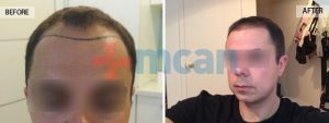 Antes y después del trasplante capilar – 9 meses después