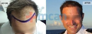 Antes y después del trasplante capilar – 9 meses después