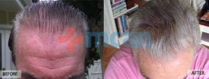 Antes y después del trasplante capilar – 1 año después