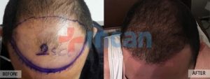 Antes y después del trasplante capilar en Turquía – 5 meses después. 4.150 injertos