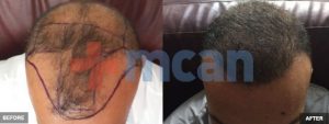 Antes y después del trasplante capilar en Turquía
