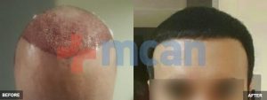 Antes y después del trasplante capilar DHI en Turquía