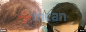 Antes y después del trasplante capilar DHI en Turquía