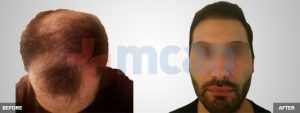 Antes y después del trasplante capilar | 2.100 injertos