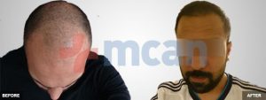 Before-After Hair Transplant | 3,100 Grafts