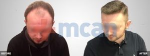 Before-After Hair Transplant | 4,100 Grafts