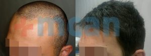 Vorher – nachher Haartransplantion | 2100 Grafts