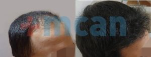 Antes y después del trasplante capilar | 2.800 injertos