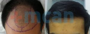 Antes y después del trasplante capilar | 3.000 injertos