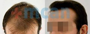 Antes y después del trasplante capilar | 3.300 injertos