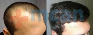 Antes y después del trasplante capilar | 2.300 injertos