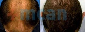 Antes y después del trasplante capilar | 3.500 injertos